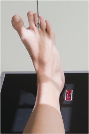 Fig. 6.84 Mortise incidență, evidențiind 15° la 20° medial