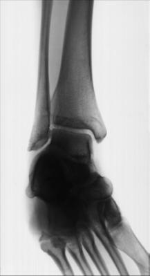 Fig. 6.85 Mortise incidență.