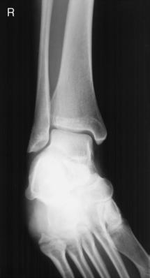 Fig. 6.86 Mortise incidență.