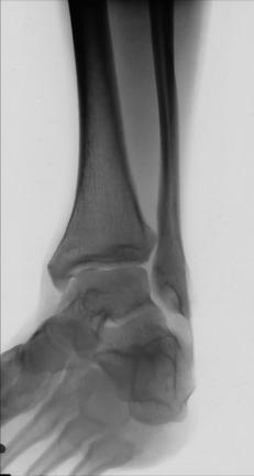 Fig. 6.88 45° AP medial oblic.