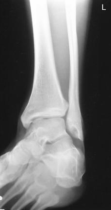 Fig. 6.89 45° AP medial