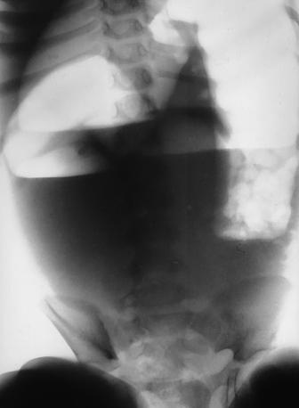 Fig. 16.63 Abdomen AP în ortostatism (evidențiază niveluri hidroaerice și