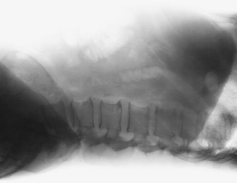 Fig. 3.44 decubit dorsal—incidență de profil drept.