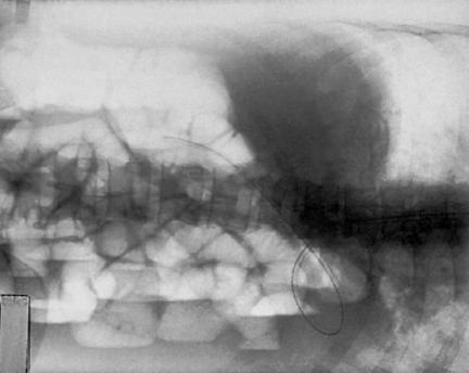 Fig. 3.38 Decubit lateral stâng (AP). (După McQuillen Martensen K: