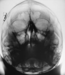 Fig. 15.82 Acanthioparietală (incidență occipito-mentonieră inversă (metoda Waters)).