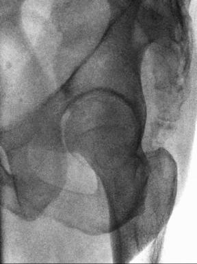 Fig. 7.63 PA axial oblic (Teufel) incidență.