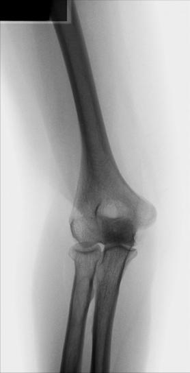 Fig. 4.127 Humerus paralel.