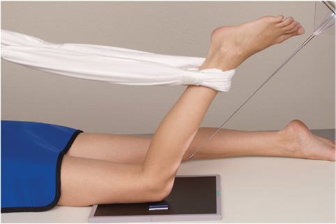 Fig. 6.139 Metoda Hughston—50° la 60° flexion.