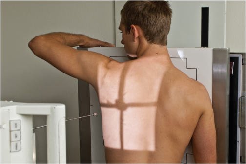 Fig. 10.42 RAO—injury la stâng anterior Coaste (Grilaj Costal), above cupole diafragmatice.