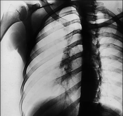 Fig. 10.43 PA Incidență Oblică. (Modified de la Rollins J, Long B,