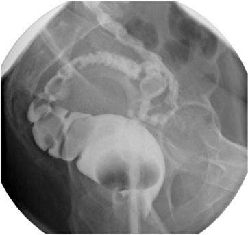 Fig. 13.74 Decubit ventral—rect în incidență de profil.