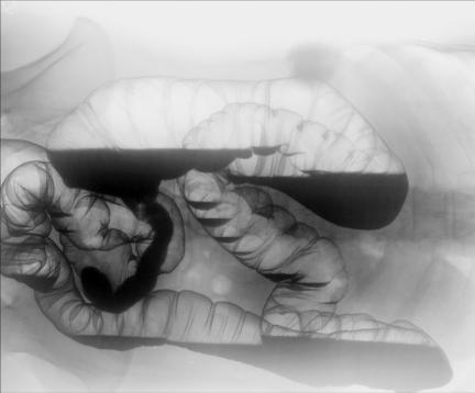Fig. 13.80 Decubit lateral stâng.