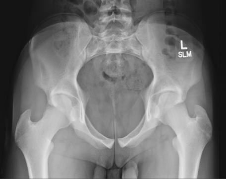 Fig. 7.52 AP axial inlet incidență.