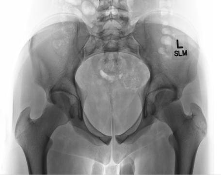 Fig. 7.51 AP axial inlet incidență.