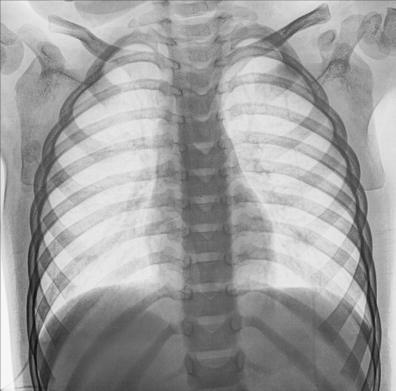 Fig. 10.37 bilateral PA Coaste (Grilaj Costal)—above cupole diafragmatice.