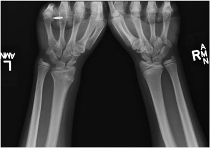 Fig. 4.106 bilateral PA stress (clenched PA) incidență.