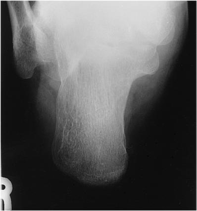 Fig. 6.73 Plantodorsal (axial) incidență.