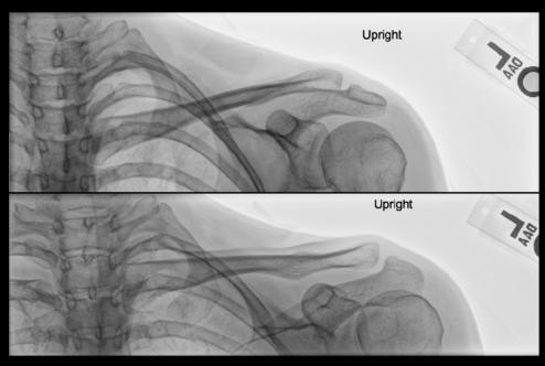 Fig. 5.89 AP axial Claviculă—raza centrală 15° la 30° cranial.