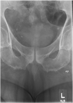 Fig. 9.67 Coccis AP axial—10° caudal.