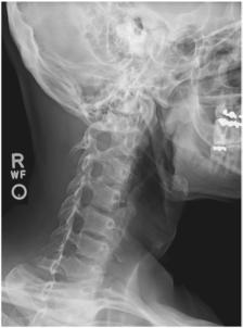 Fig. 8.55 Oblică posterioară stângă.
