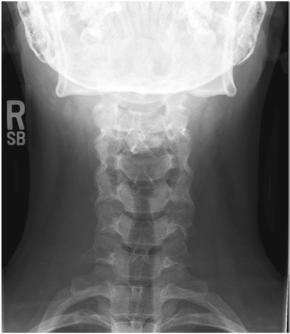 Fig. 8.51 AP axială, unghi cranial de 15°.
