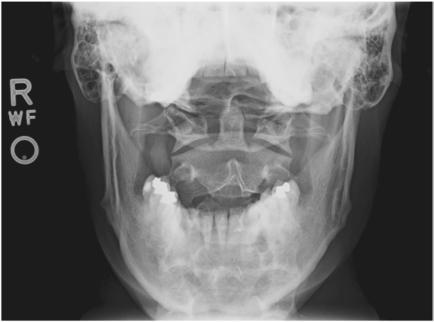 Fig. 8.48 AP gură deschisă (transorală)—C1 până la C2.