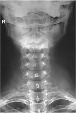 Fig. 8.75 Radiografie AP cu