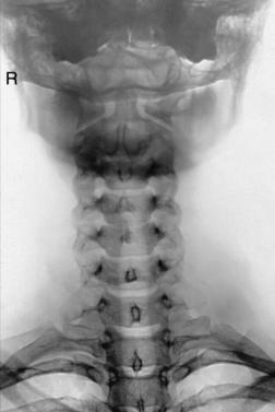 Fig. 8.76 AP „mandibulă oscilantă”.