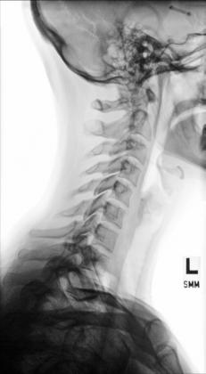 Fig. 8.58 stâng lateral.