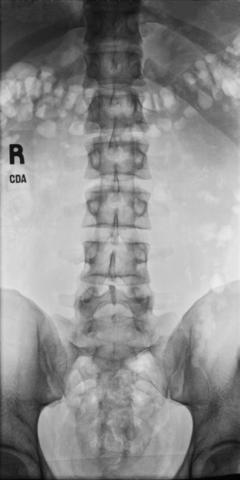 Fig. 9.30 Incidență lombară AP.