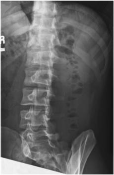 Fig. 9.31 RPO la 45° în ortostatism a coloanei lombare, evidențiind partea dreaptă (imagine inserată) [fragment incomplet în sursă]