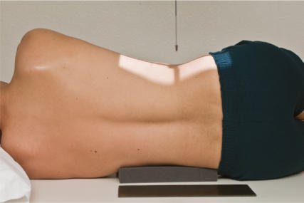 Fig. 9.35 incidență lombară stângă de profil (raza centrală 5° caudal).