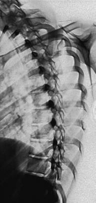 Fig. 8.90 RAO Coloană Toracală.