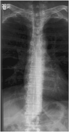 Fig. 8.81 AP Coloană Toracală.