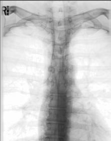 Fig. 8.82 AP Coloană Toracală.