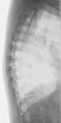 Fig. 8.85 incidență de profil a coloanei toracale.