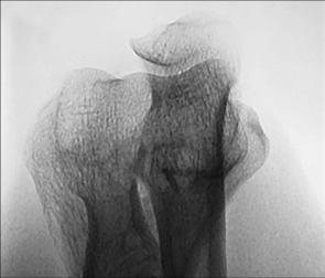 Fig. 4.133 distal Humerus.