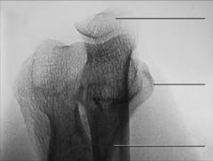 Fig. 4.131 distal Humerus.