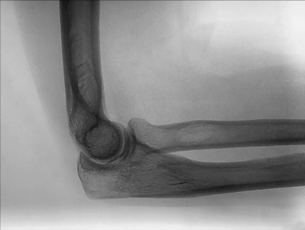 Fig. 4.143 lateral—Cot flectat 90° (Antebraț paralel cu receptorul de imagine).