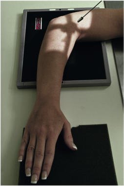 Fig. 4.148 Decubit dorsal, înclinat 45° pentru