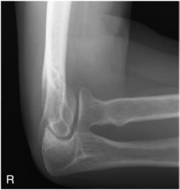 Fig. 4.150 pentru cap radial.