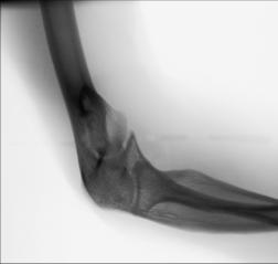 Fig. 4.151 pentru proces coronoid.
