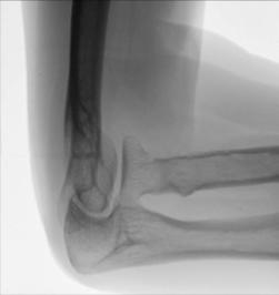 Fig. 4.153 axial mediolateral