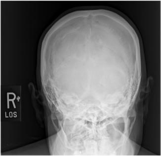 Fig. 11.109 AP axială.
