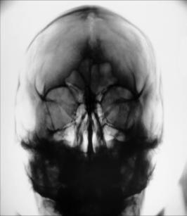 Fig. 11.113 PA axială—raza centrală 15° caudal, linia orbitomeatală (LOM) perpendiculară; inserție (săgeată continuă)