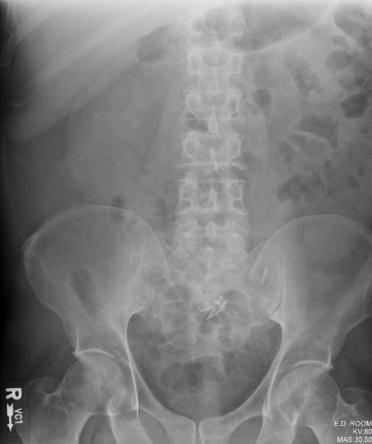 Fig. 3.29 Abdomen inferior AP—orientare verticală. (Din Grajo JR și colab.:
