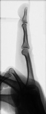 Fig. 4.49 Fourth falange.