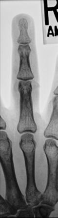 Fig. 4.37 PA—fourth falange.