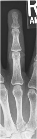Fig. 4.38 PA—fourth falange.