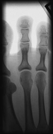Fig. 6.42 AP second falange.